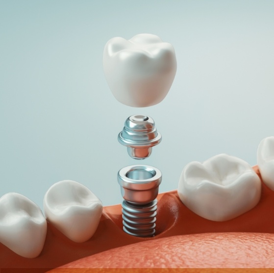Illustrated dental crown being placed onto a dental implant