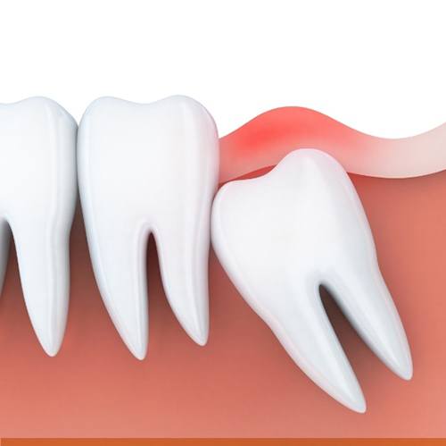 Illustration of a wisdom tooth pushing against back molar