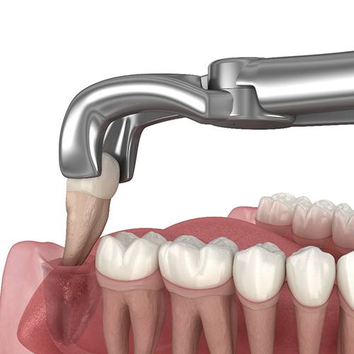 Illustration of a tooth being extracted